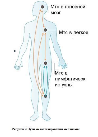 Метастазы меланомы в мозг мрт