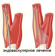 Атеросклероз синдром такаясу стеноз сонных артерий