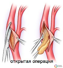 Атеросклероз сонных артерий хирургическое лечение