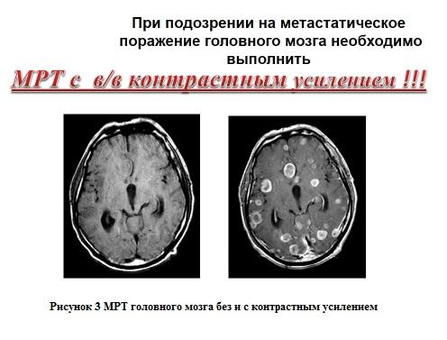 Мрт головного мозга метастазы меланомы