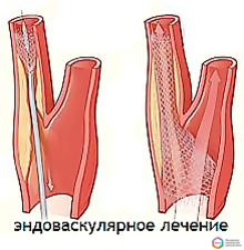 Атеросклероз сонных артерий хирургическое лечение