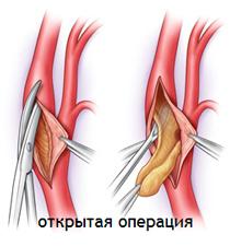 Атеросклероз синдром такаясу стеноз сонных артерий